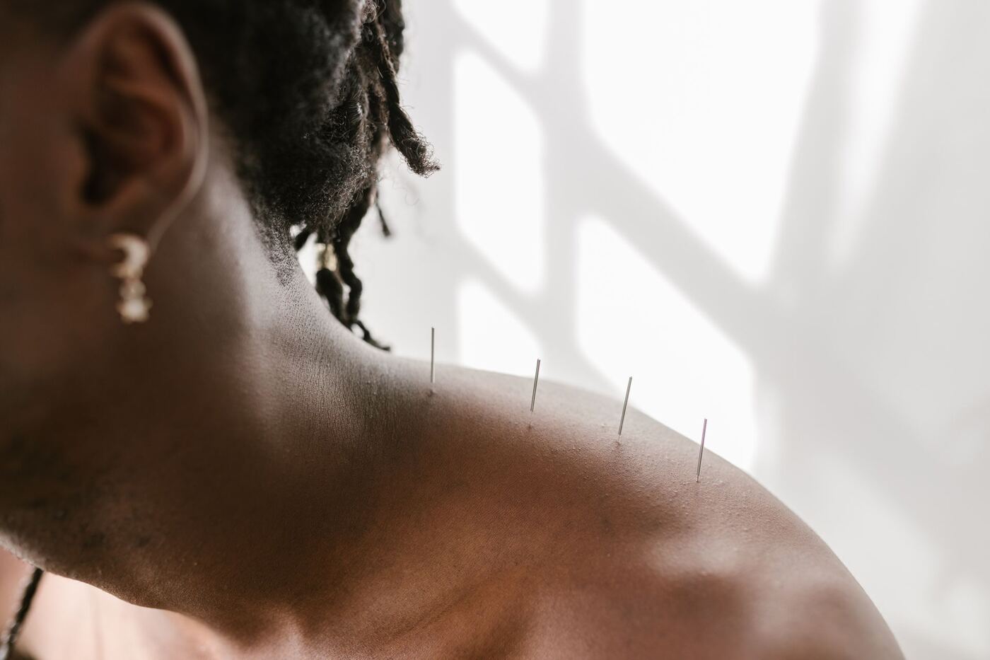 Man resting comfortably with acupuncture needles along the upper back during treatment in New Jersey