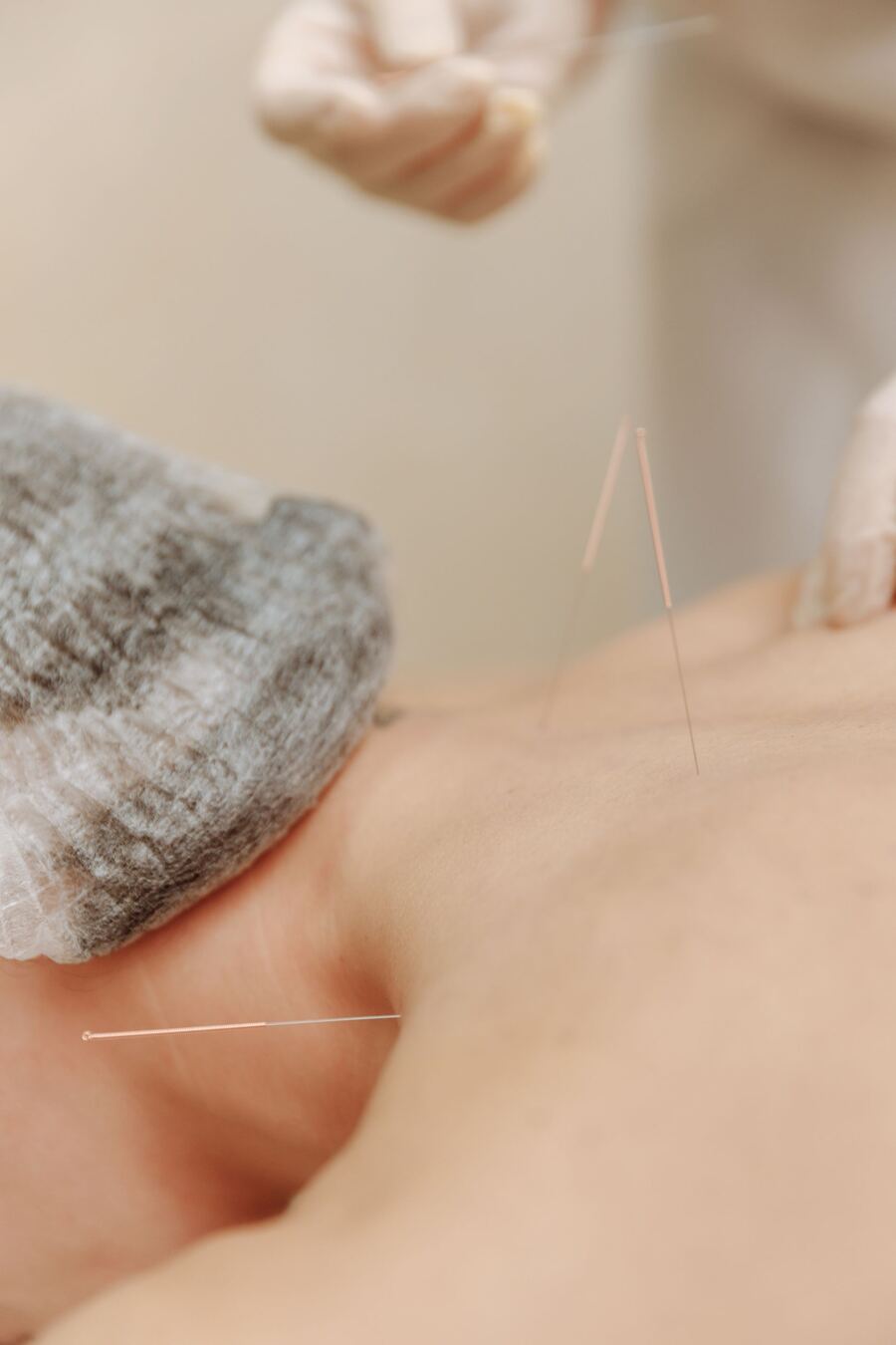 Licensed acupuncturist placing sterile single-use needles along the back at New Jersey Acupuncture and Wellness Center in Morristown