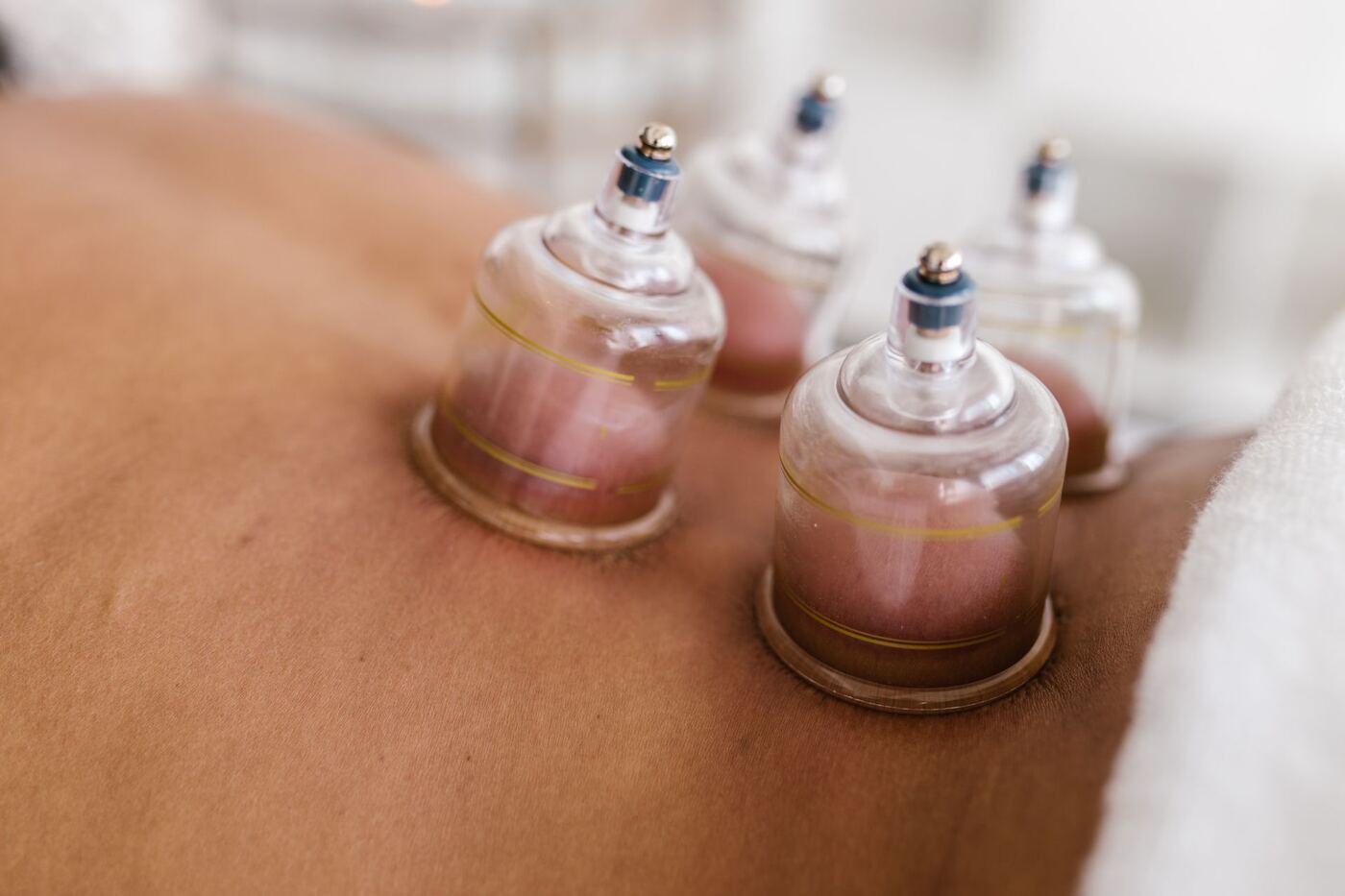 Three glass cups placed on a patient's back during cupping therapy in Morristown New Jersey