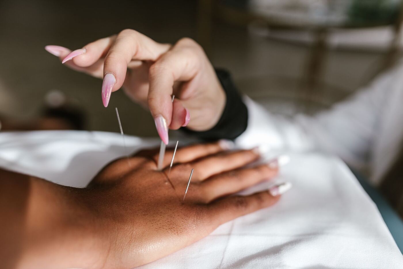 Acupuncturist working on microsystem points of the hand, similar to auricular ear point therapy