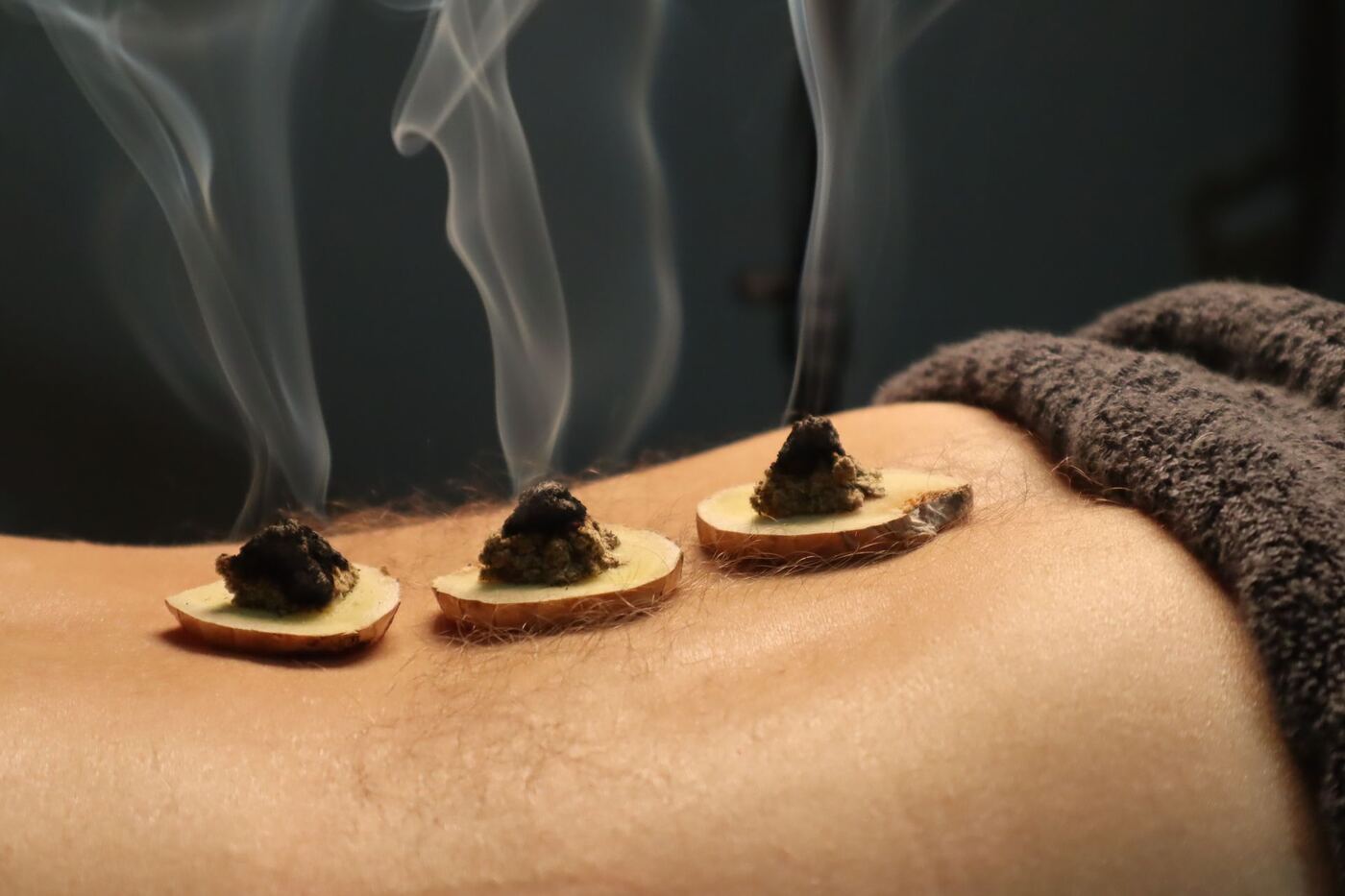 Small burning moxa cones resting on protective bases on a patient's skin during moxibustion