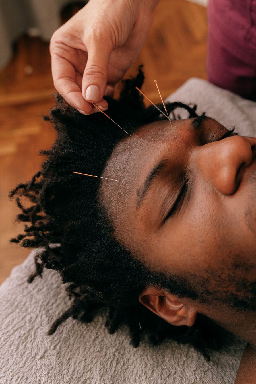 Fine acupuncture needles placed on the forehead and hairline during scalp acupuncture for neurological recovery